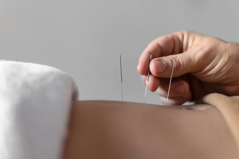 Acupuntura Médica
