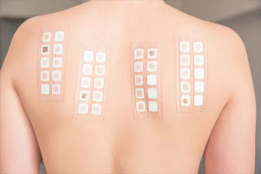 Pricktest e Patchtest