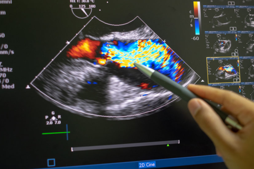 Ultrassom das artérias carótidas com Doppler e modo b
